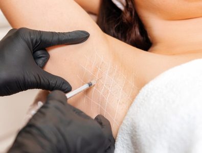 بوتاکس زیر بغل