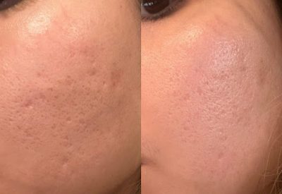 مزونیدلینگ