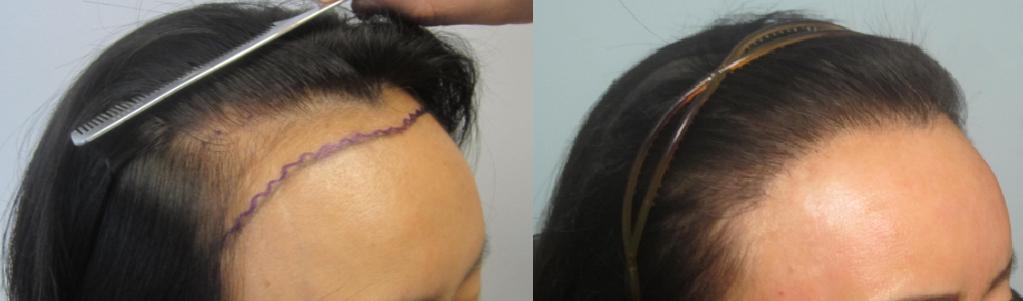 کاشت مو زنان